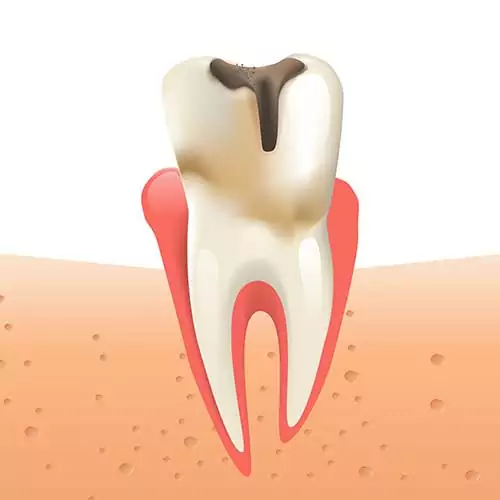 tooth decay
